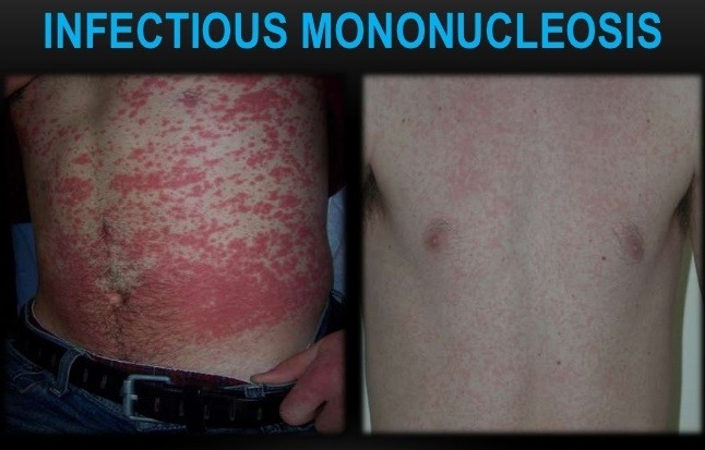 Infectious Mononucleosis Pictures