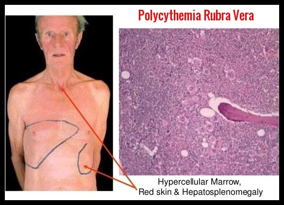 Polycythemia Rubra Vera - Ask Hematologist