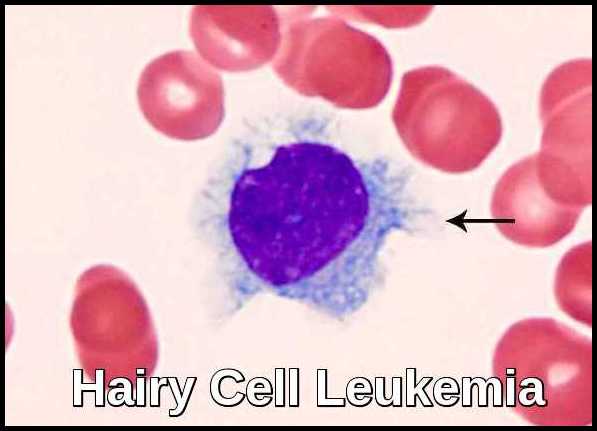 Hairy Cell Leukemia Ask Hematologist Understand Hematology