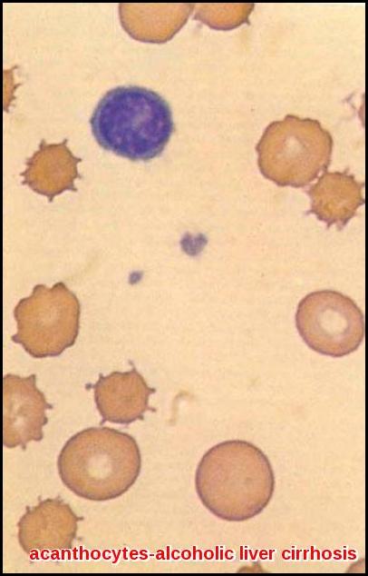 Acanthocytosis in alcoholic liver cirrhosis peripheral blood smear Acanthocytosis showing spur cells in peripheral blood smear from a patient with alcoholic liver cirrhosis