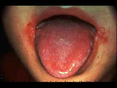 Clinical image of Angular Stomatitis due to Iron Deficiency Anemia