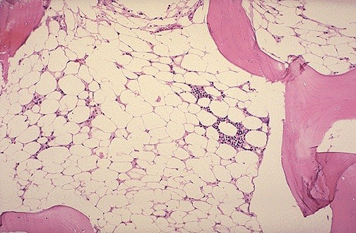 aplastic anemia bone marrow biopsy