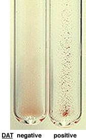 Direct Antiglobulin Test showing negative sample without agglutination and positive sample with red cell clumping