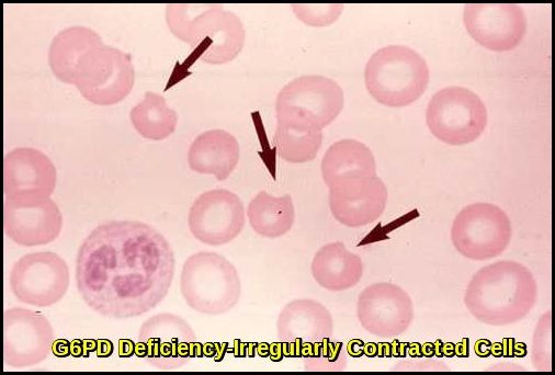 Irregularly contracted red blood cells seen in G6PD deficiency during oxidative haemolysis.