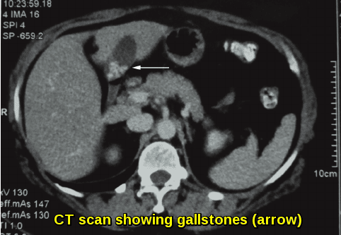 CT scan showing pigment gallstones in a patient with chronic hemolytic anemia