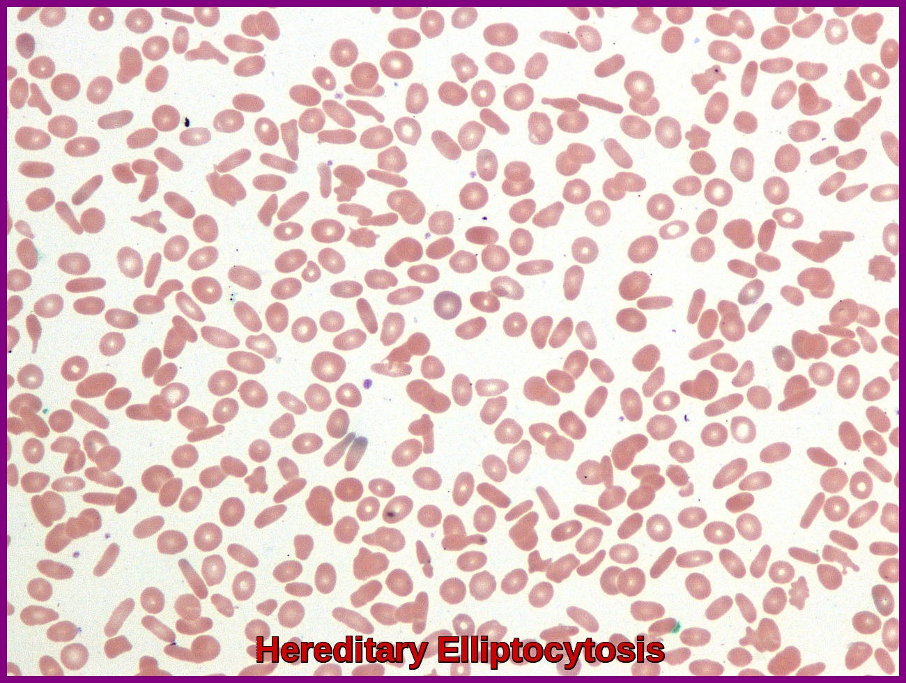 Hereditary Elliptocytosis