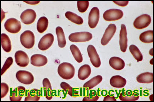 Hereditary Elliptocytosis (Ovalocytosis) – elliptocytes and ovalocytes on blood smear Peripheral blood smear demonstrating both elliptocytes and ovalocytes characteristic of hereditary elliptocytosis/ovalocytosis.
