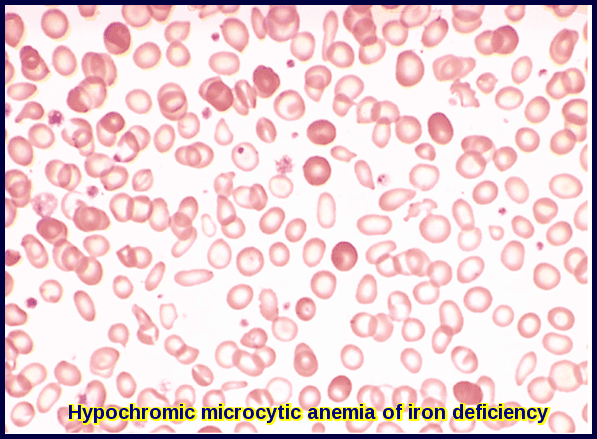 Peripheral blood film showing microcytic hypochromic red blood cells in Iron Deficiency Anemia