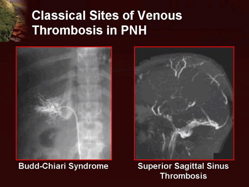 paroxysmal nocturnal hemoglobinuria statistics