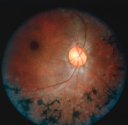 Retinitis Pigmentosa