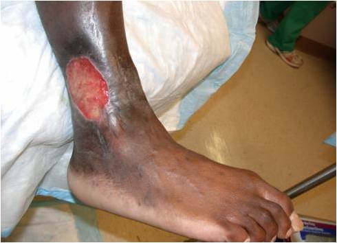 sickle cell anemia hand foot syndrome