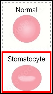 Stomatocytosis