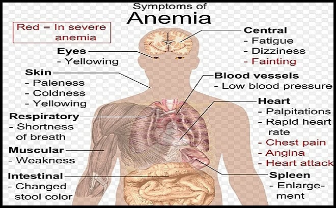 Anemia symptoms diagram showing fatigue pallor dizziness shortness of breath palpitations and systemic effects