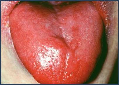 Iron Deficiency Anemia