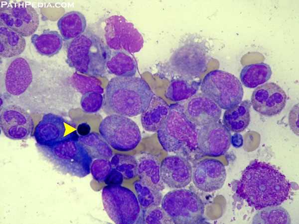 Pure Red Cell Aplasia