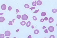 schistocytes - fragmented red blood cells
