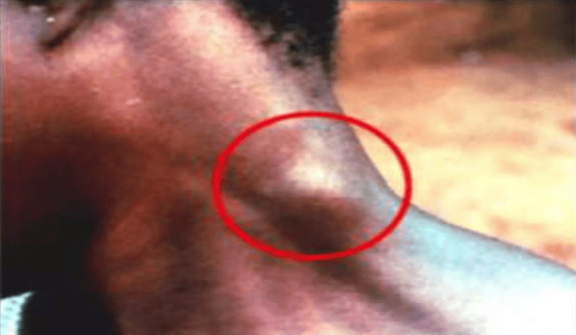 Swollen lymph nodes in the posterior neck, a sign of African Trypanosomiasis (Winterbottom's sign).