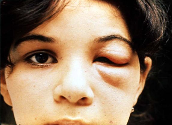 Unilateral periorbital swelling (Romaña's sign), an initial manifestation of American Trypanosomiasis (Chagas disease).