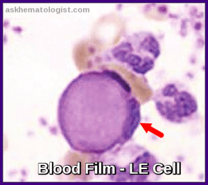 Lupus Erythematosus (LE) Cells