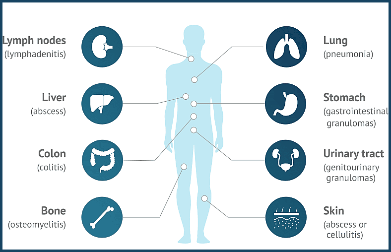 Diagram showing common organ involvement and complications in Chronic Granulomatous Disease, including lymphadenitis, liver abscess, colitis, osteomyelitis, pneumonia, gastrointestinal granulomas, genitourinary granulomas, and skin abscesses