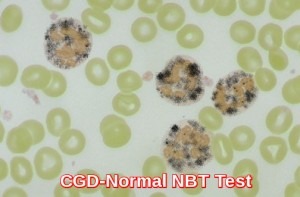 CGD-Normal NBT Test