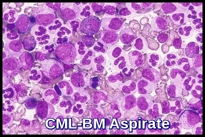 Marrow hypercellular with gross myeloid hyperplasia