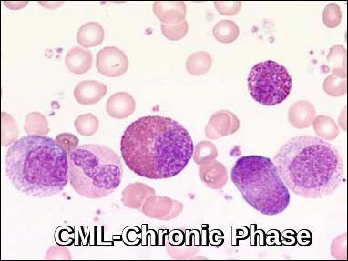 Peripheral blood smear in chronic myeloid leukemia chronic phase showing mature granulocytes and left-shifted precursors