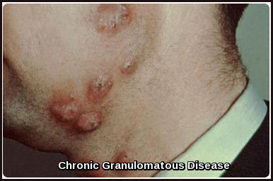 Chronic Granulomatous Disease