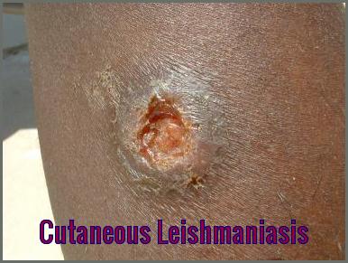 Leishmaniasis-Skin Ulcer