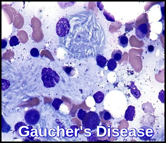 Genetics/Birth Defects as related to Gaucher's Disease - Pictures