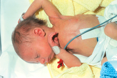 hemolytic disease of the newborn