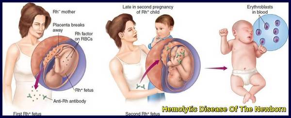 Medical illustration showing Rh-negative mother sensitization to Rh-positive fetal red blood cells, antibody formation, and hemolysis affecting a subsequent Rh-positive fetus, demonstrating the pathophysiology of Hemolytic Disease of the Newborn.