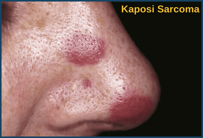 Kaposi Sarcoma lesions on the nose in an HIV-positive patient showing classic violaceous nodules