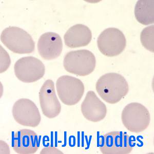 Miscellaneous Red Cell Abnormalities