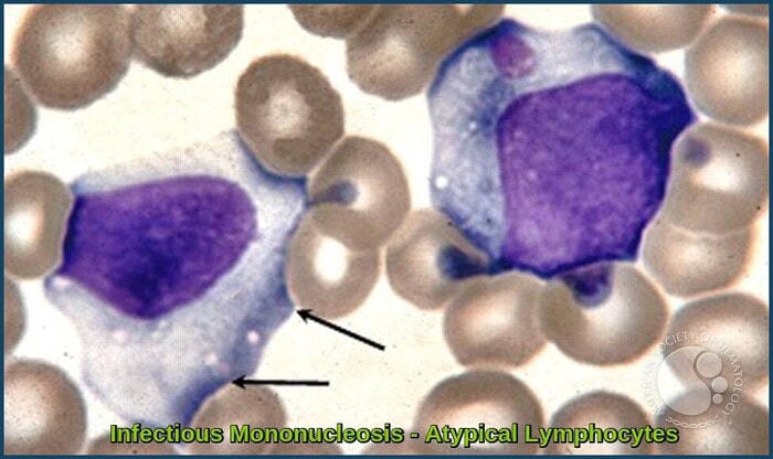 Atypical lymphocytes on peripheral blood smear in infectious mononucleosis, showing enlarged cells with abundant basophilic cytoplasm and irregular nuclei