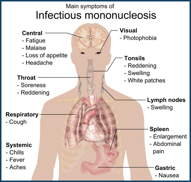 Infographic showing main symptoms of infectious mononucleosis, including fatigue, sore throat, swollen tonsils, lymphadenopathy, splenomegaly, fever, and systemic symptoms.