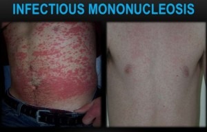 Infectious Mononucleosis-Skin Rash