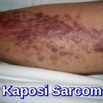 Kaposi Sarcoma on the leg showing multiple violaceous plaques and nodules in an HIV-positive patient