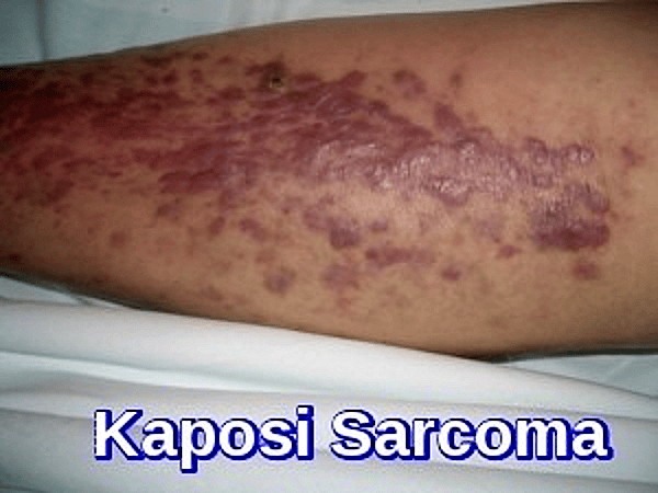 Kaposi Sarcoma on the leg showing multiple violaceous plaques and nodules in an HIV-positive patient – Dr Moustafa Abdou – AskHematologist