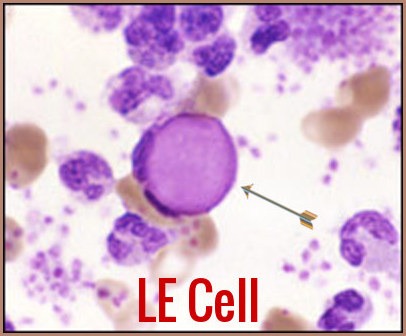 Lupus Erythematosus (LE) Cells