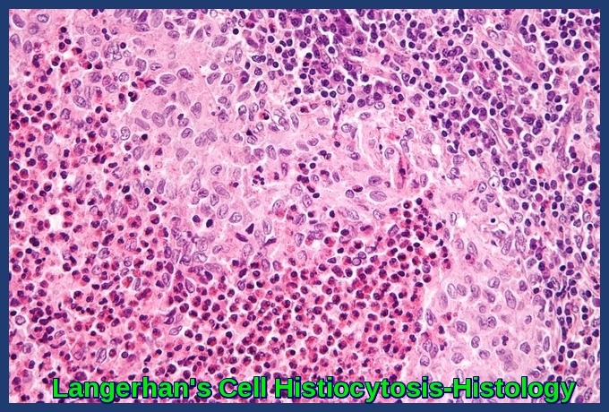 Langerhan's Cell Histiocytosis-Histology