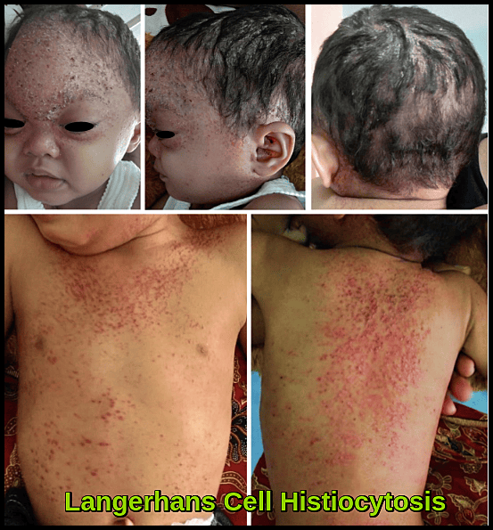 Multiple images showing infant with Langerhans Cell Histiocytosis presenting with crusted scalp lesions and diffuse erythematous papules on the trunk and back