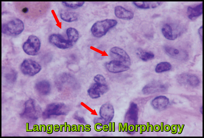 Microscopic image showing Langerhans cells with grooved coffee-bean nuclei characteristic of Langerhans Cell Histiocytosis