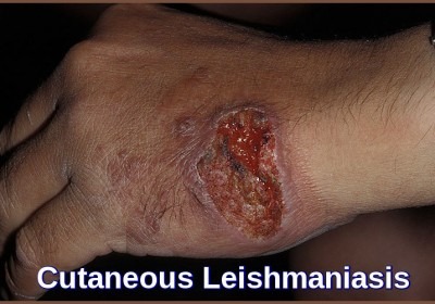 Cutaneous Leishmaniasis