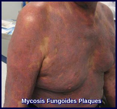 erythematous plaques in advancing mycosis fungoides