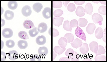Malaria-Plasmodium Ovale
