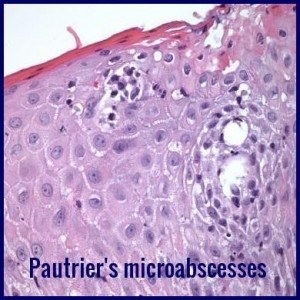Pautrier's microabscesses