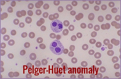 Pelger-Huet anomaly