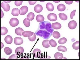 Sezary Cell