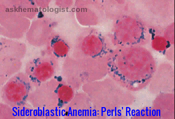 Sideroblastic Anemia-Perls Reaction